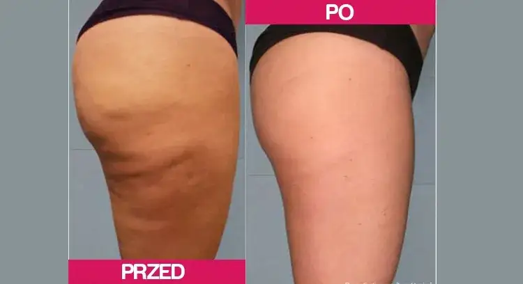 przed i po masażu antycellulitowym