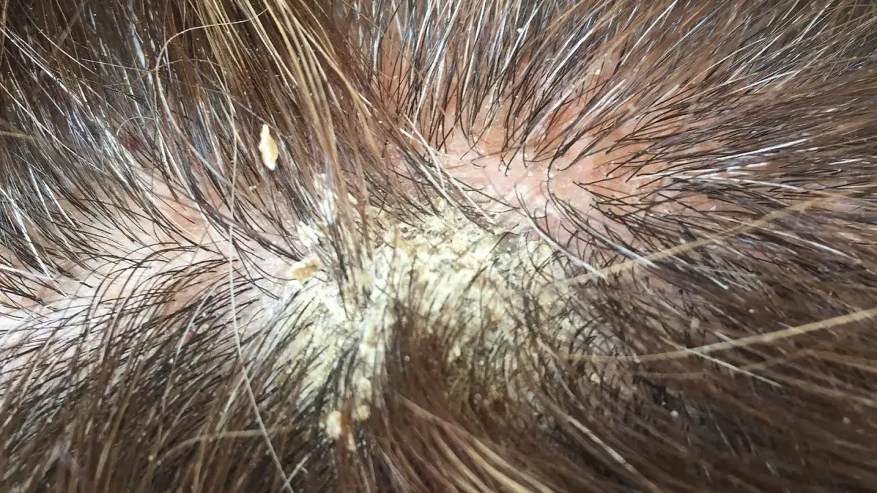 Cuero cabelludo con descamación amarillenta y cabello oscuro. Podría ser un caso que necesite vital plus fs.