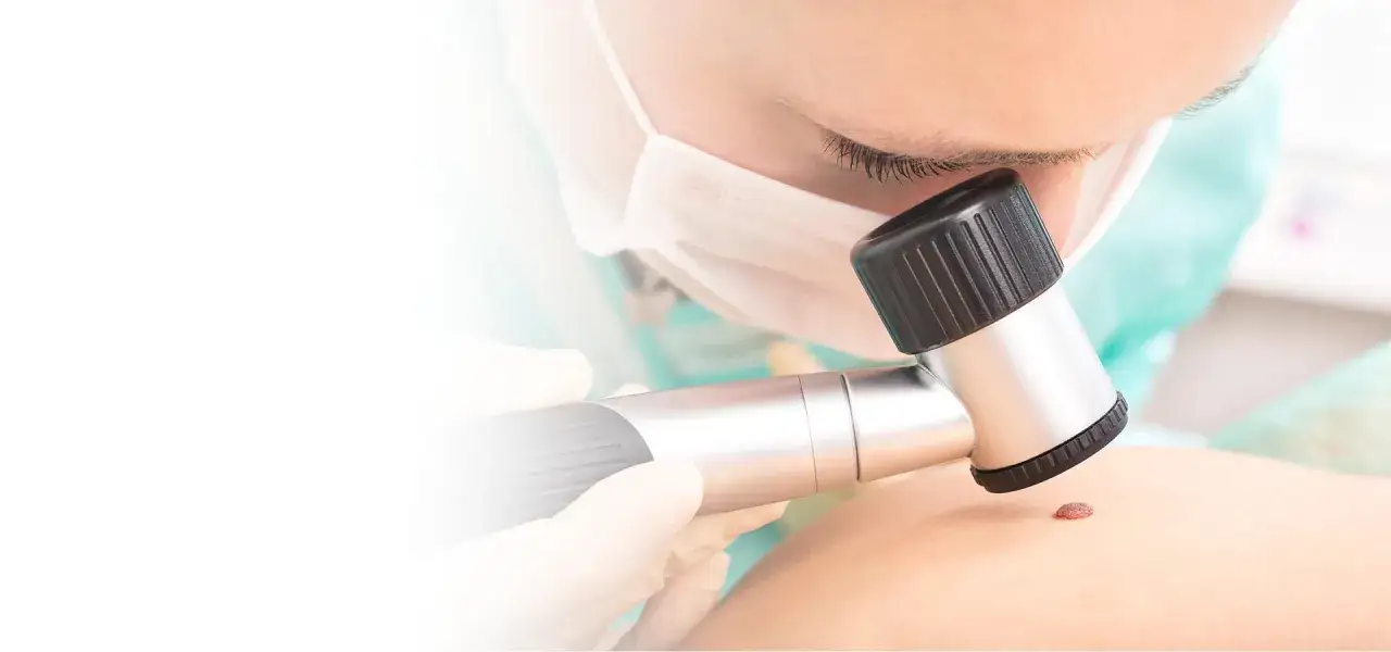 Dermatolog w masce bada znamie dermatoskopem.