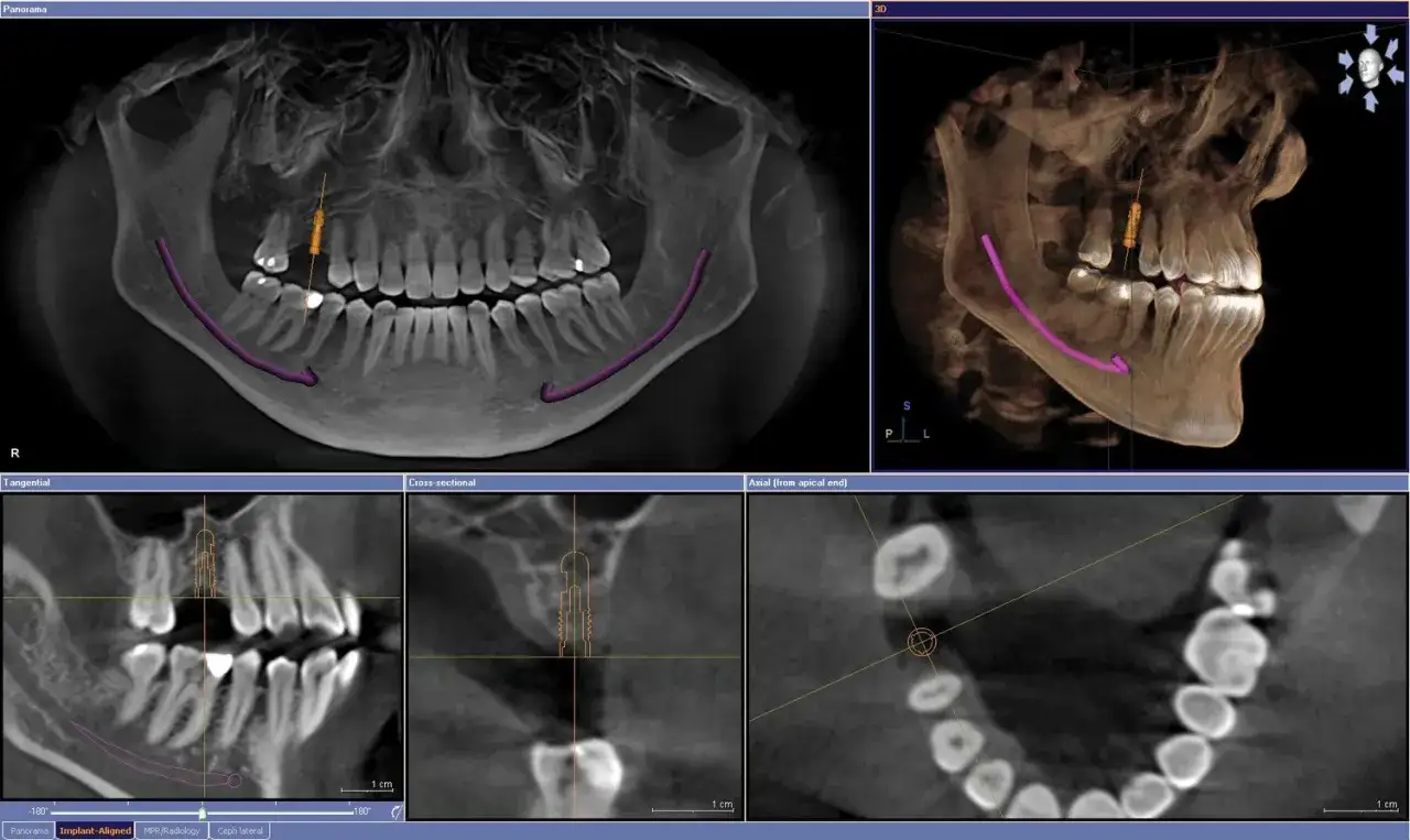 CBCT co to? Obraz przedstawia trójwymiarowe skanowanie szczęki z widocznym implantem i planowaną ścieżką jego umieszczenia.