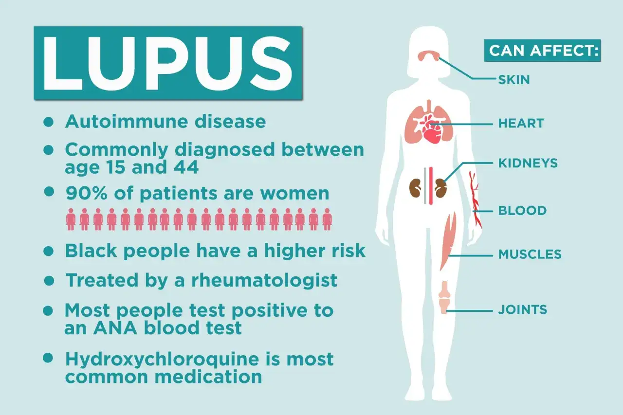 Grafika o lupus: choroba autoimmunologiczna, częściej u kobiet, dotyka skórę, serce, nerki, krew, mięśnie i stawy.