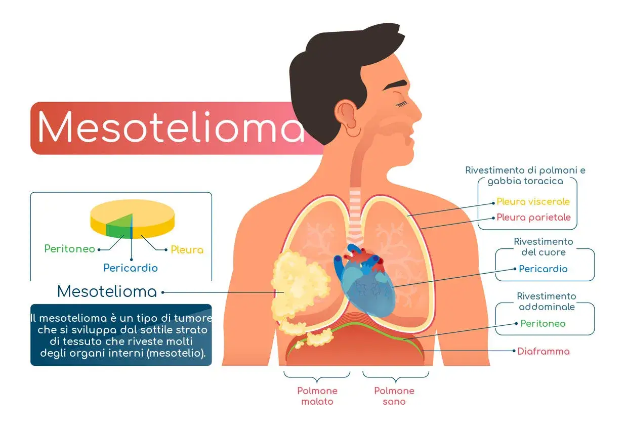 Il mesotelioma è un tumore del mesotelio, il sottile strato che riveste gli organi interni. L'immagine mostra la sua localizzazione in pleura, pericardio e peritoneo.