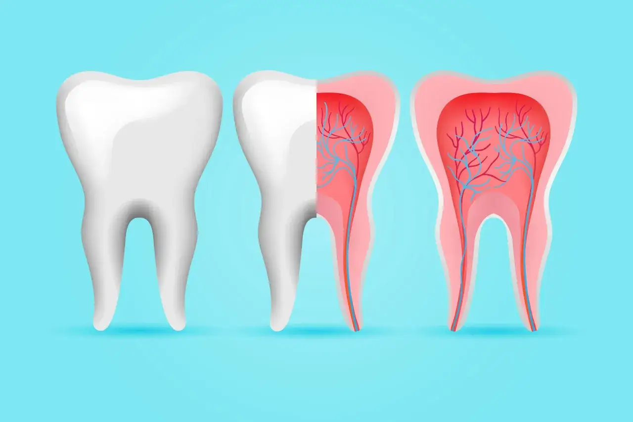 Corte transversal de una muela mostrando la pulpa dental con vasos sangu&iacute;neos. La inflamaci&oacute;n de la pulpa, o pulpitis muela, puede ser dolorosa.