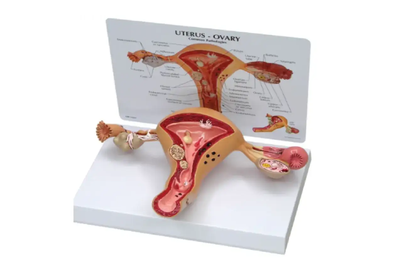Model anatomiczny narządu rodnego kobiety z widocznymi jajnikami, macicą i jajowodami. Na tablicy obok schemat patologii.