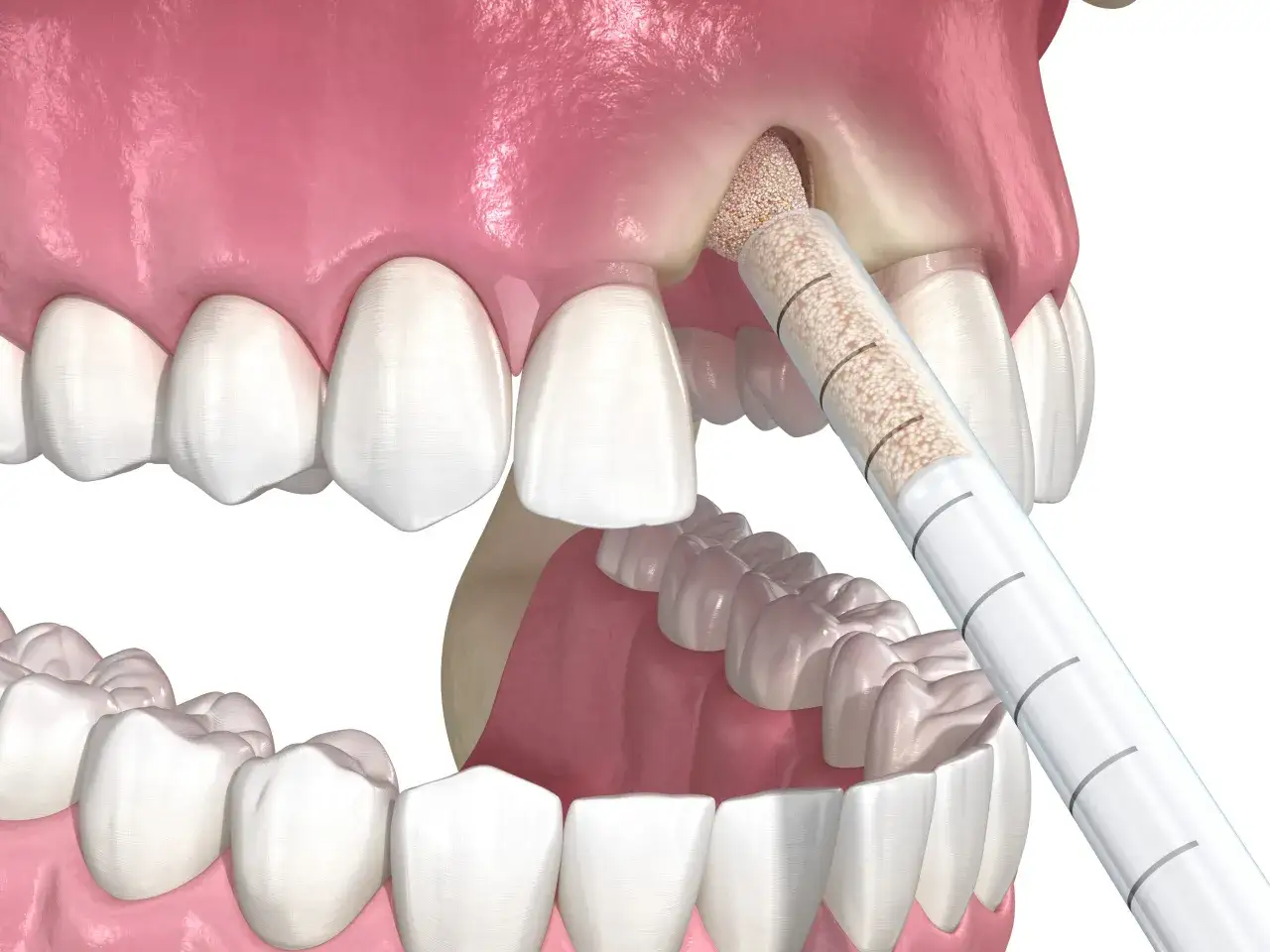 Zabieg augmentacji kości: materiał kostny wprowadzany jest do ubytku, przygotowując miejsce pod implant. Zapobiega to odrzuceniu przeszczepu kości pod implant.