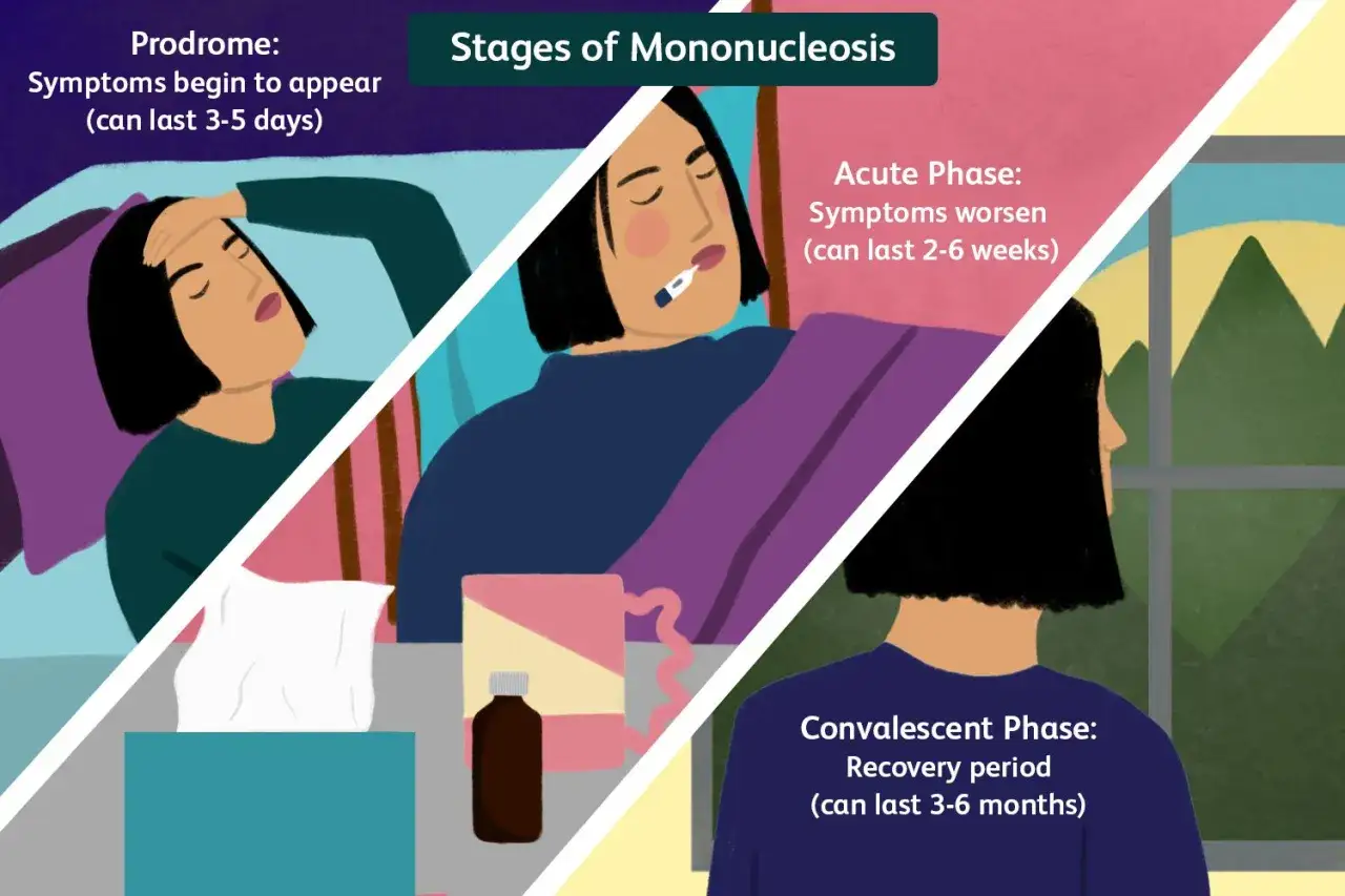 Les étapes de la mononucléose : prodrome (3-5 jours), phase aiguë (2-6 semaines) et convalescence (3-6 mois).