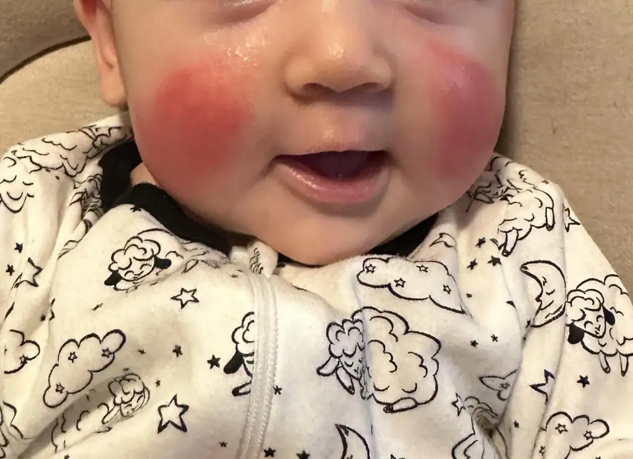 Visage de bébé avec joues rouges, possiblement signe de dermatite atopique. Il porte une tenue ornée de moutons et d'étoiles.