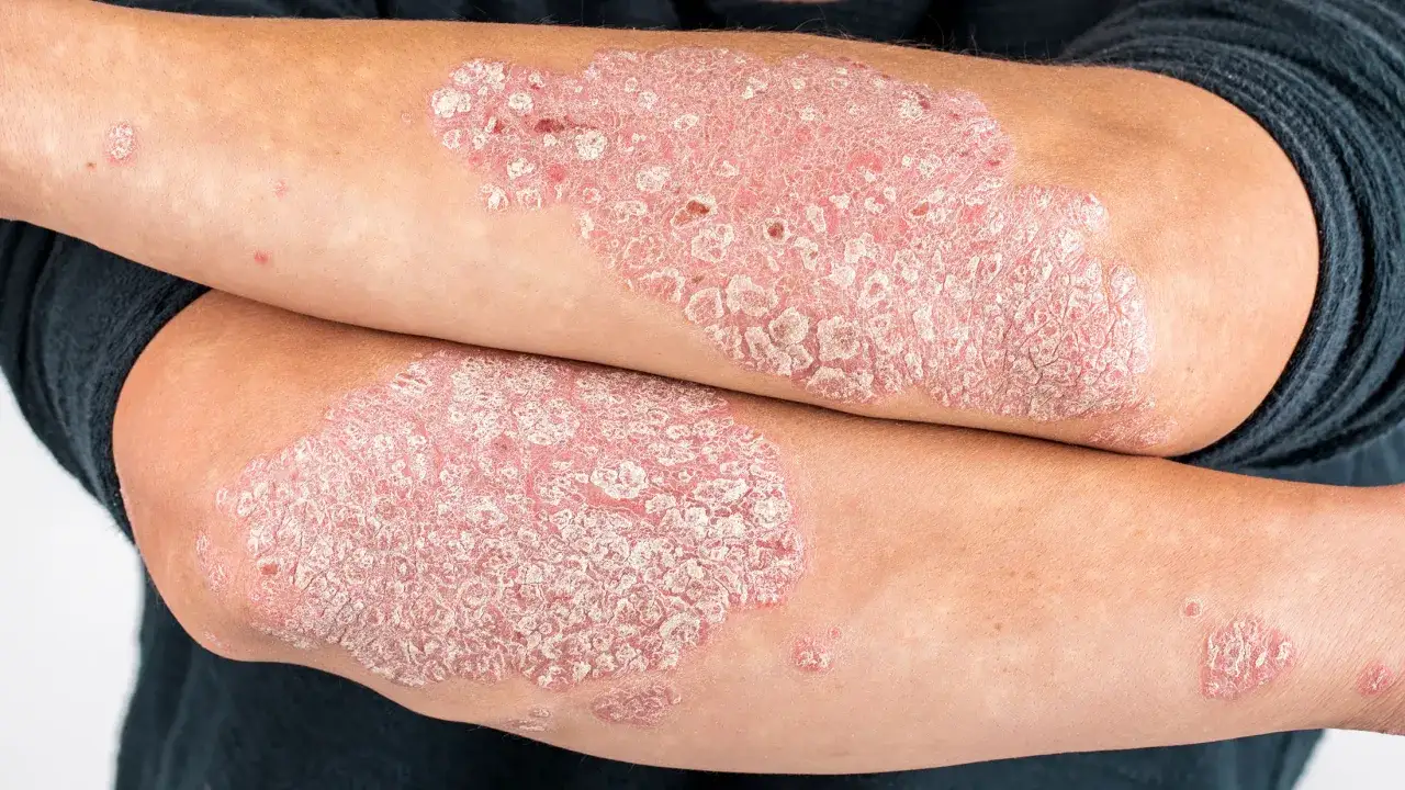 Sk&oacute;ra na ramionach z widocznymi, łuszczącymi się zmianami. Czy łuszczyca można się zarazić? Nie, to choroba autoimmunologiczna.