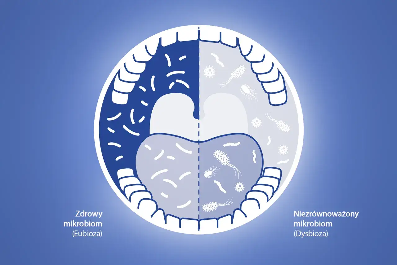 Porównanie zdrowego i niezrównoważonego mikrobiomu jamy ustnej. Niezrównoważenie może prowadzić do skutków ubocznych, jak przy stosowaniu np. Eludril.