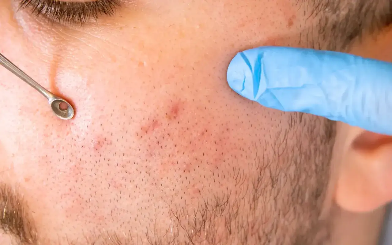 Un outil pour comment se d&eacute;barrasser d'un bouton sous la peau est utilis&eacute; sur une peau avec des imperfections.