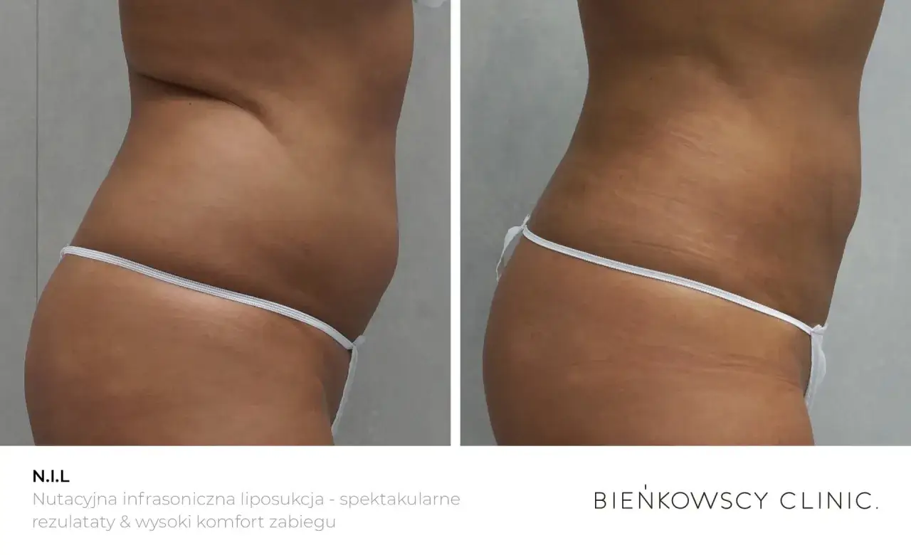 Przed i po zabiegu N.I.L. - nutacyjna ultrasoniczna liposukcja. Zobacz, co to jest liposukcja i jakie daje efekty.