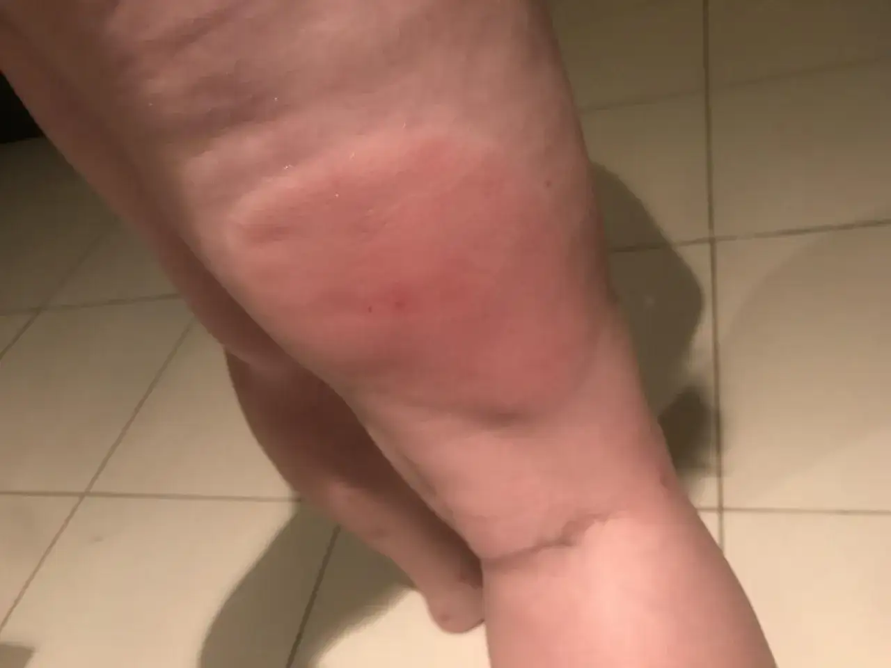 Grosse rougeur sur la cuisse, signe d'une allergie à un bouton de moustique.