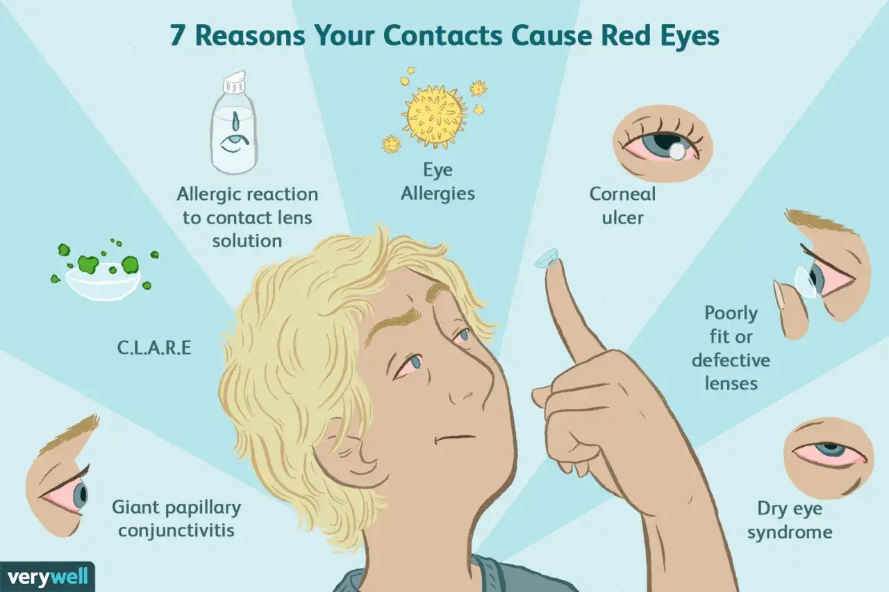 Illustrazione che spiega perchè le lenti a contatto mi danno fastidio: allergie, soluzioni, lenti difettose, secchezza oculare e congiuntivite.