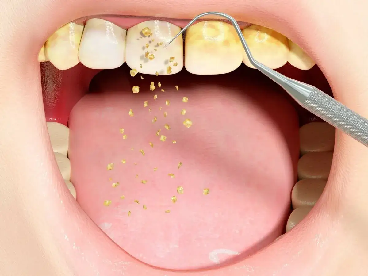 Złote, nieestetyczne bakterie na zębach są usuwane przez dentystyczne narzędzie.