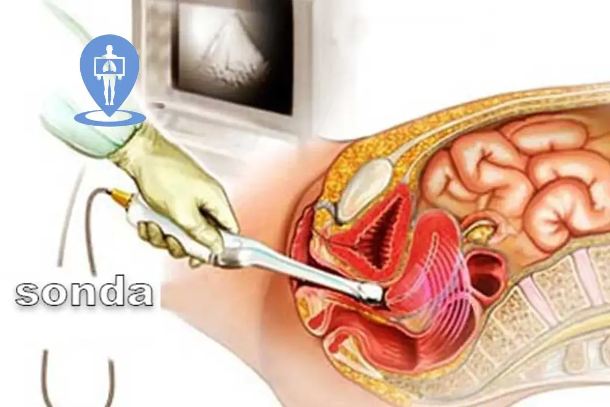 Illustrazione di un'ecografia transvaginale, con una sonda che esplora l'utero e gli organi pelvici.
