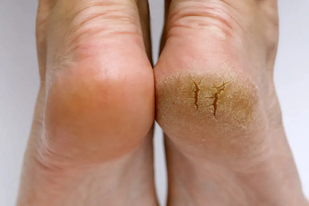 Pieds montrant une crevasse talon sévère, un problème courant traité par un podologue.