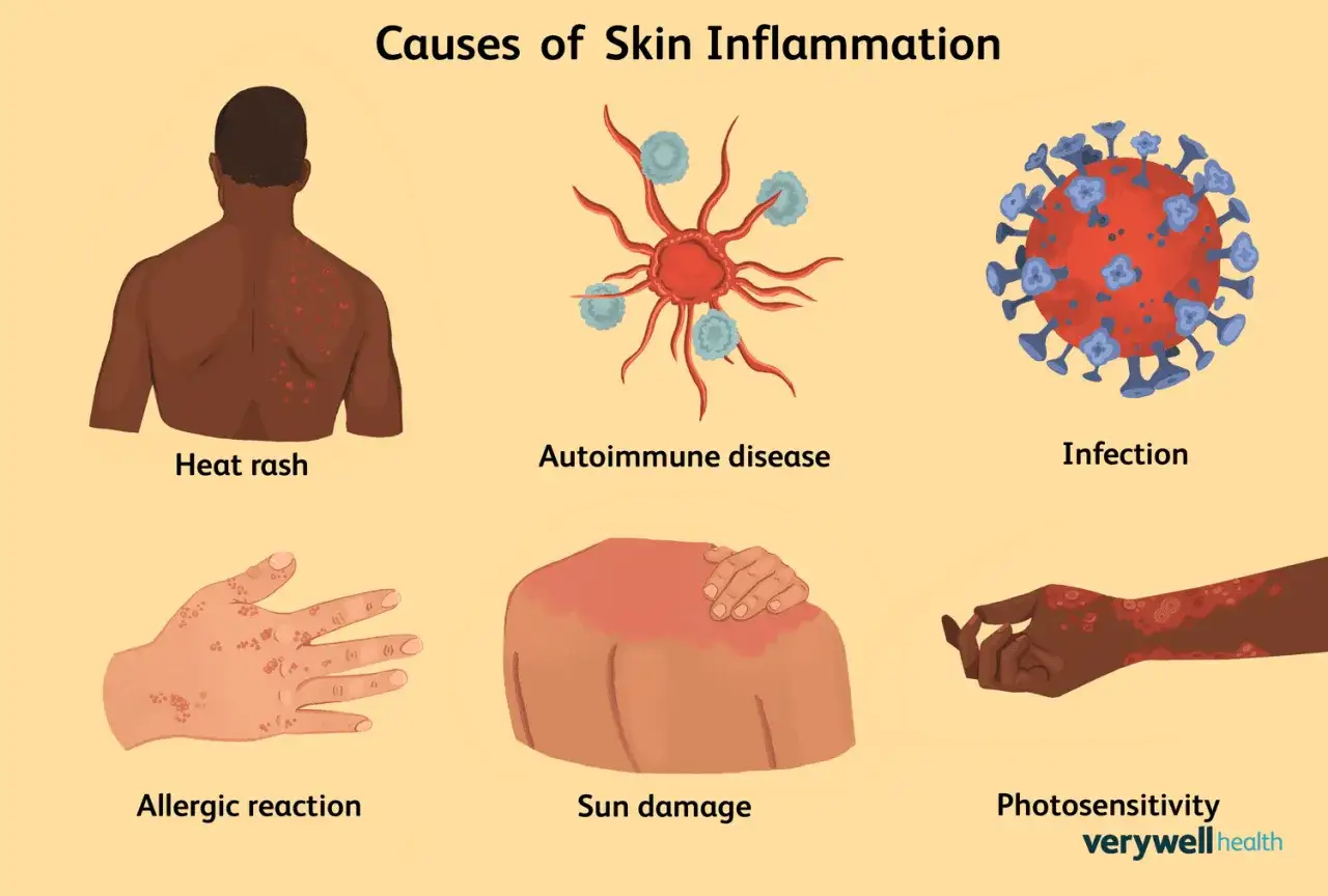 Illustration des causes d'inflammation cutan&eacute;e : coup de soleil, maladie auto-immune, infection, r&eacute;action allergique, coup de chaleur, photosensibilit&eacute;. Comprendre pourquoi la peau gratte.
