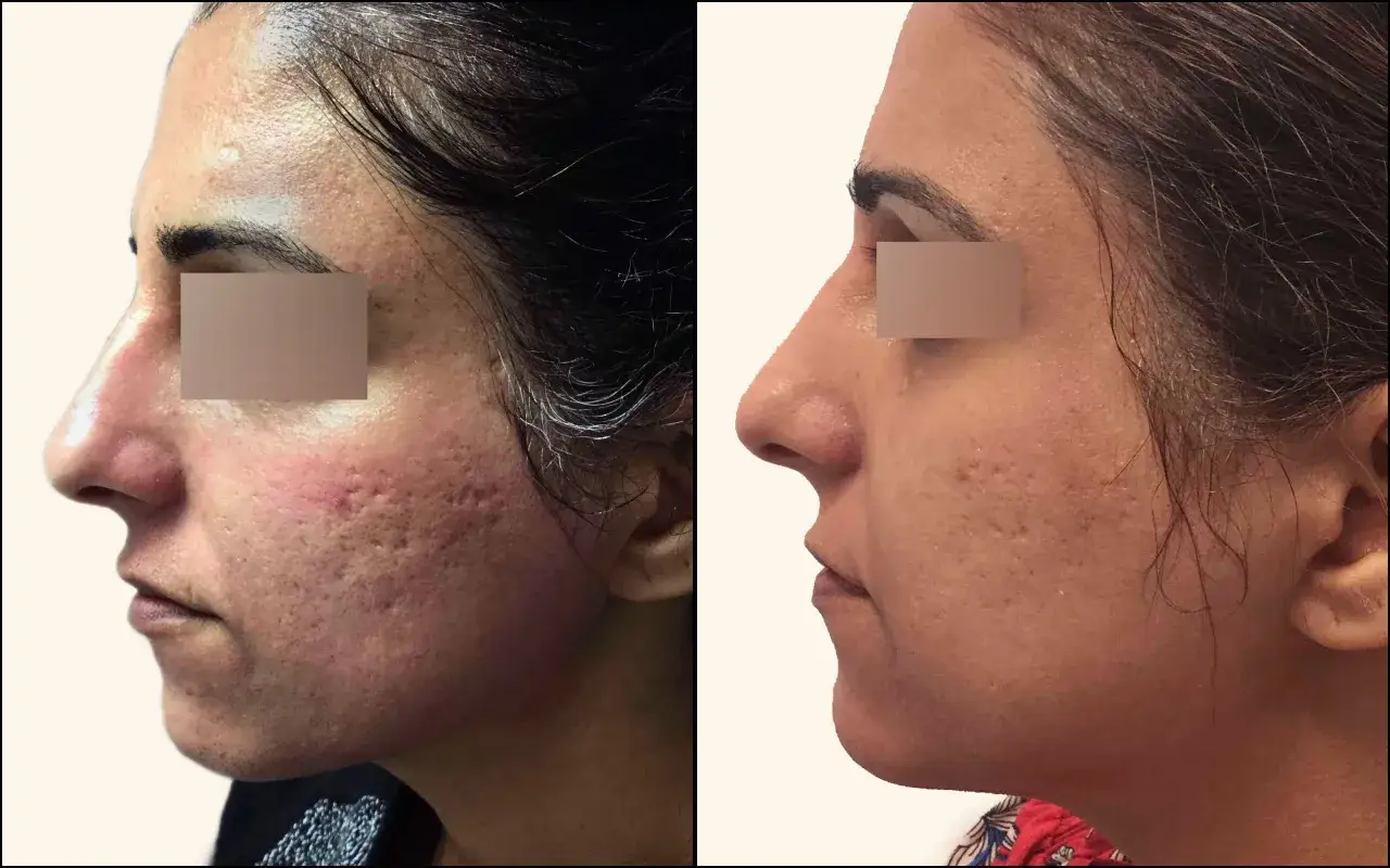 Comparaci&oacute;n antes y despu&eacute;s de tratamiento para como quitar marcas de acn&eacute;. La piel luce m&aacute;s lisa y uniforme.