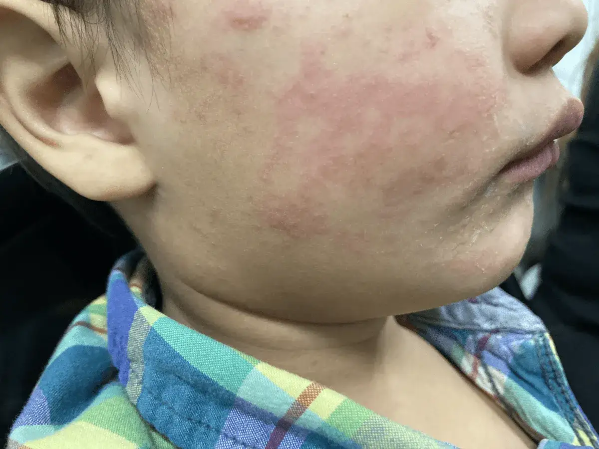 Rostro de ni&ntilde;o con erupci&oacute;n rojiza, posible s&iacute;ntoma de sarampi&oacute;n en ni&ntilde;os.