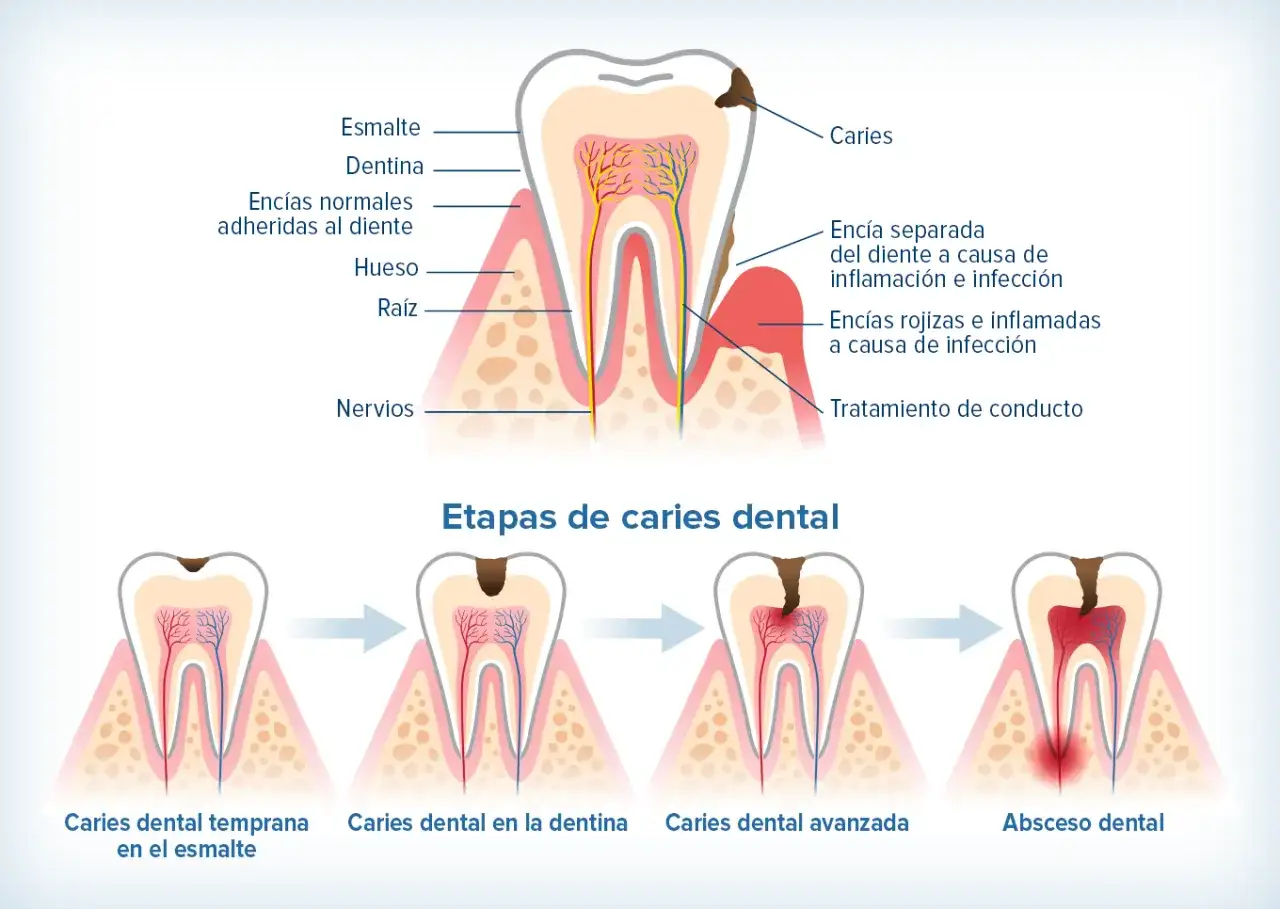 Ilustración muestra las caries etapas: temprana en esmalte, en dentina, avanzada y absceso dental. Detalla anatomía del diente y encías.