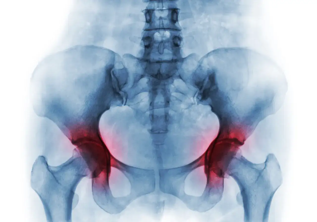 Radiografia del bacino con evidenziate in rosso le aree di dolore alle ossa ischiatiche.