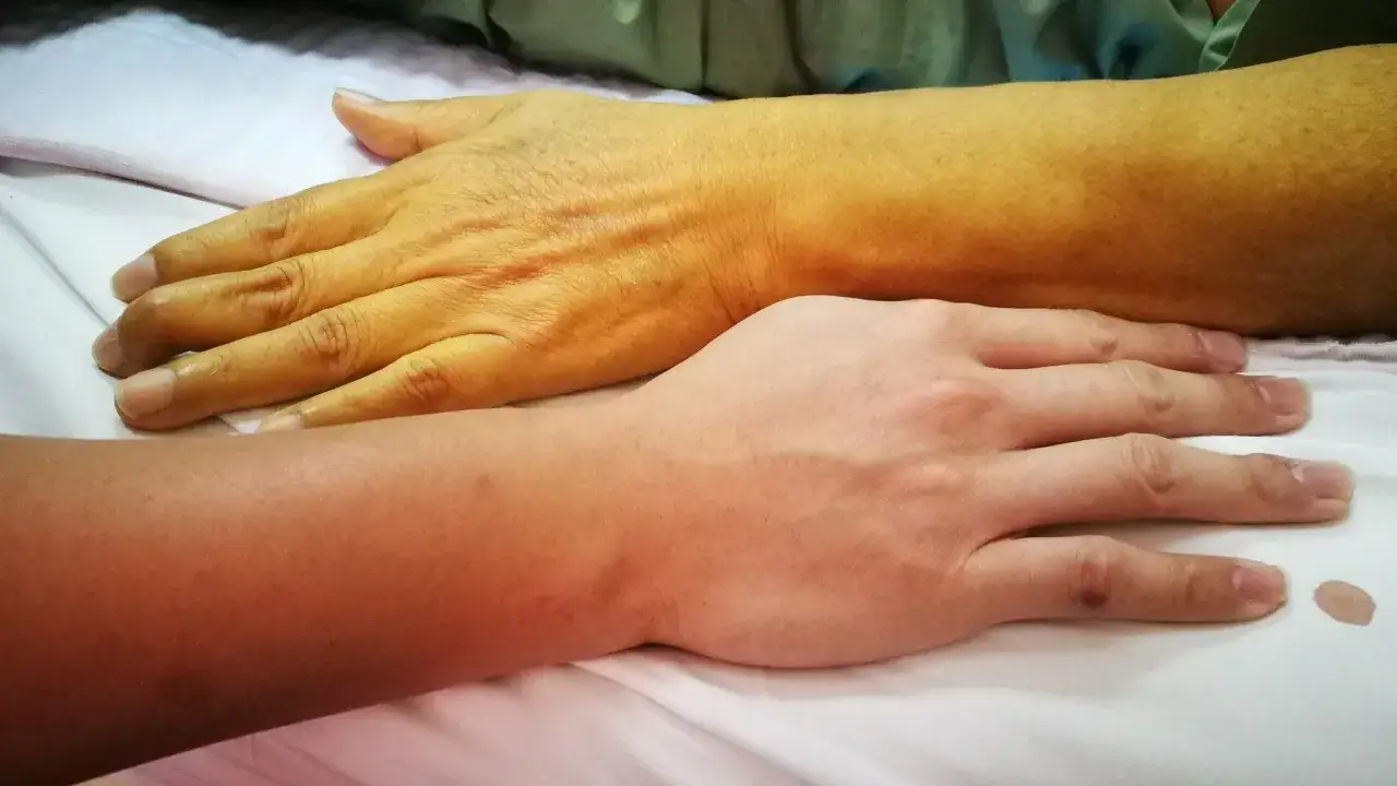 Dłoń z żółtym zabarwieniem skóry, wskazującym na cholestazę, obok zdrowej dłoni.