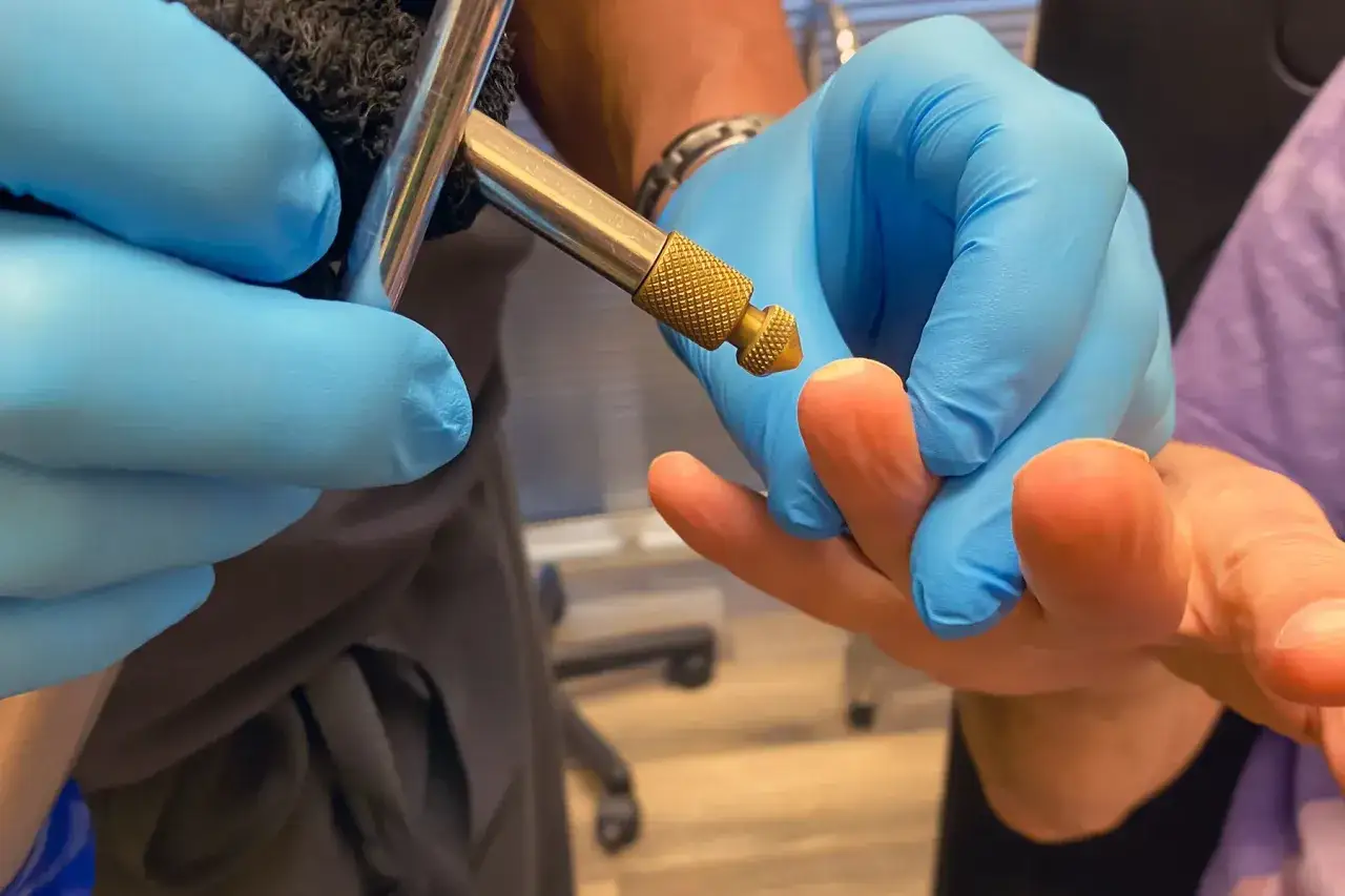 Manos enguantadas con azul usan un instrumento para quemar verrugas en un dedo.