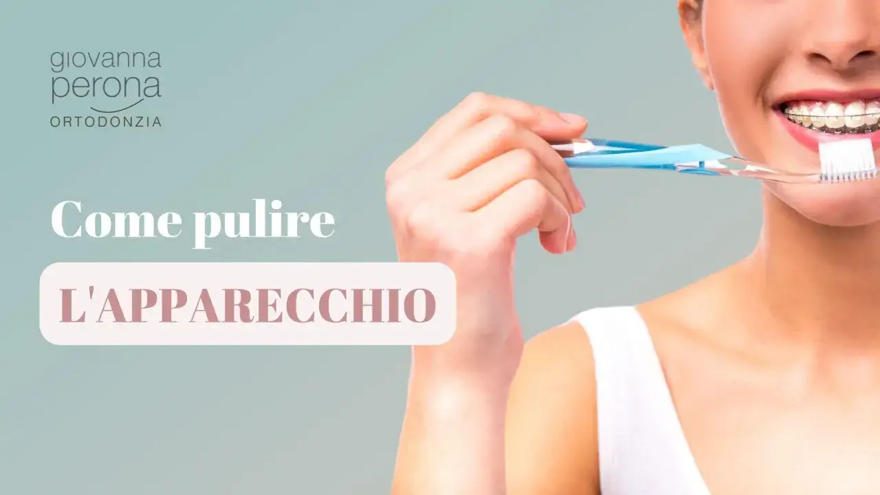 Donna con apparecchio ortodontico ai denti inferiori che si lava i denti con uno spazzolino blu.