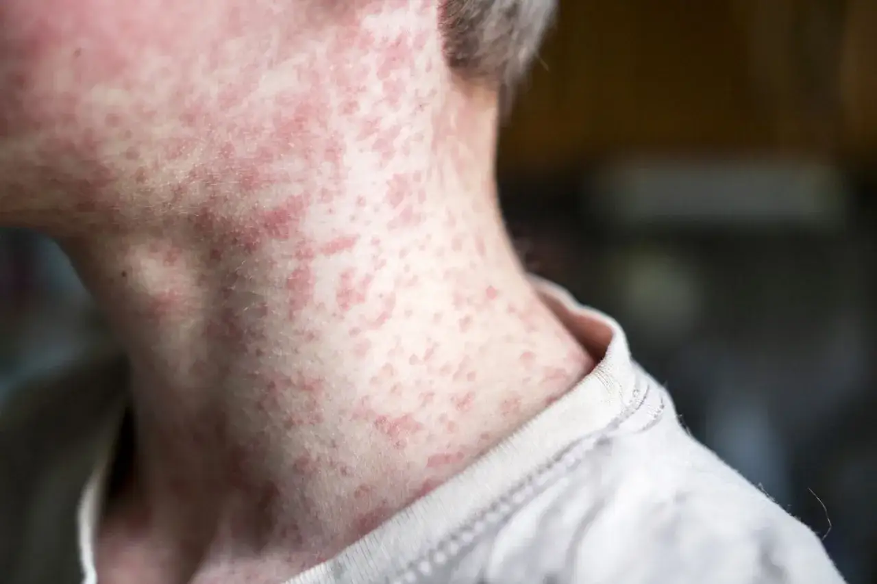 Närbild på en persons hals och nacke med utslag som tyder på rosacea på kroppen.