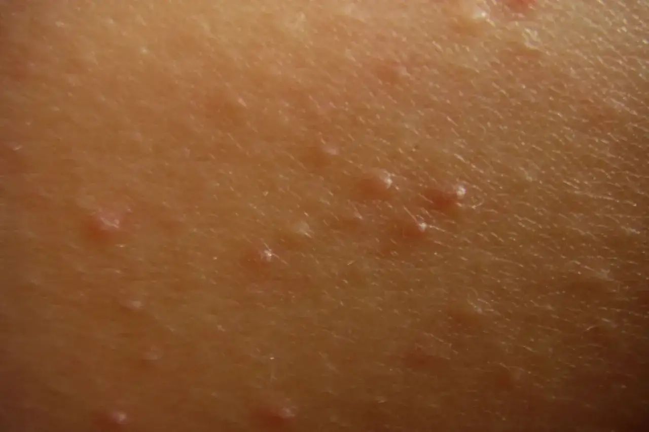 N&auml;rbild p&aring; hud med sm&aring;, upph&ouml;jda prickar som indikerar keratosis pilaris.