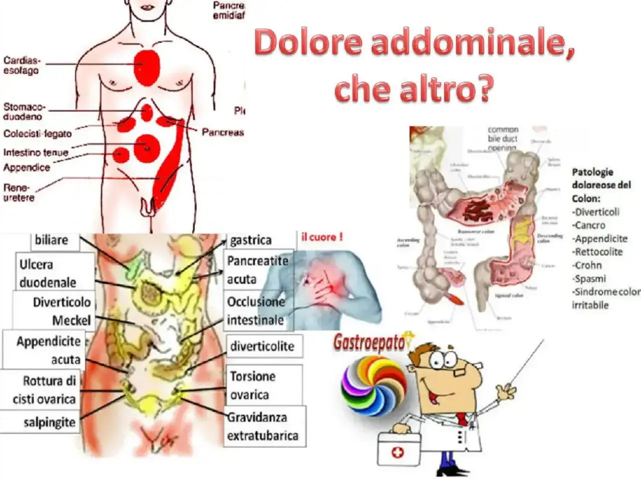 Illustrazione anatomica che mostra le cause di fitte allo stomaco, tra cui appendicite, diverticolite e problemi biliari.