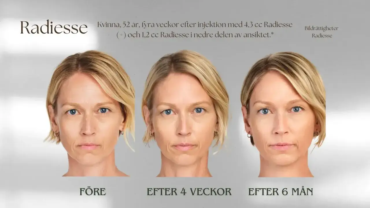 F&ouml;re- och efterbilder av en 52-&aring;rig kvinna som genomg&aring;tt en Radiesse behandling f&ouml;r att f&ouml;rb&auml;ttra ansiktets konturer.
