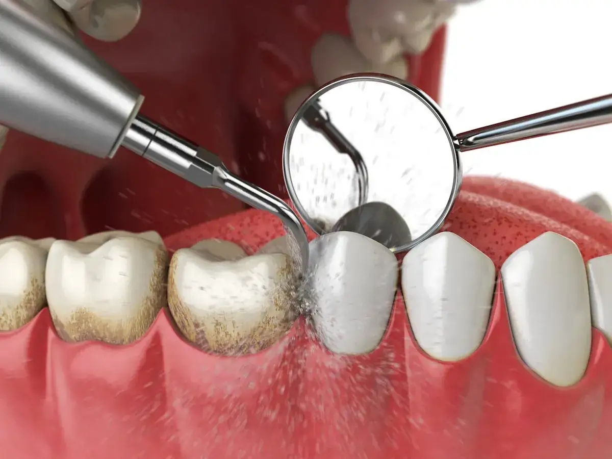Piaskowanie zębów w domu: urządzenie usuwa kamień i osad, przywracając biel. Lustereczko dentystyczne pomaga w precyzyjnym czyszczeniu.