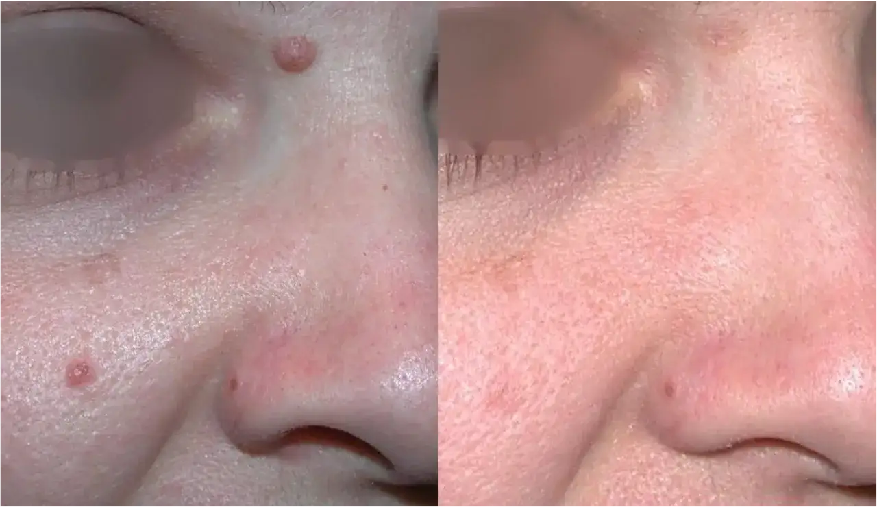 Comparaison avant/après traitement d'un grain de beauté qui dépasse sur le visage.