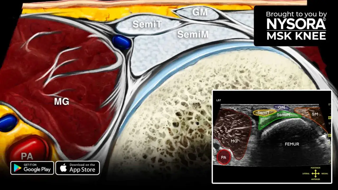 Anatomie du genou montrant le muscle gastrocnémien (MG) et les tendons (SemiT, SemiM, GM). Une échographie illustre la localisation d'un kyste poplité.