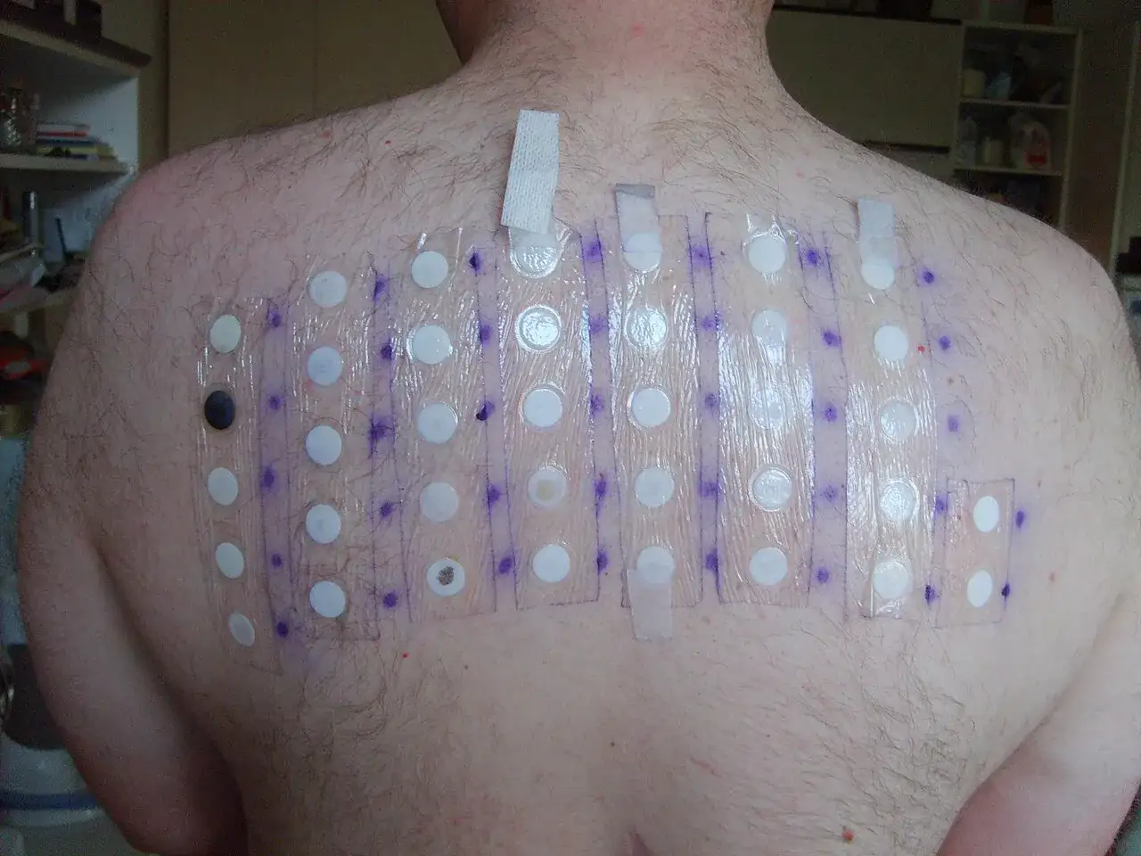 Plecy pacjenta z przyklejonymi plastrami do **testów alergicznych**. Widać okrągłe, białe krążki i zaznaczone fioletowym markerem punkty.