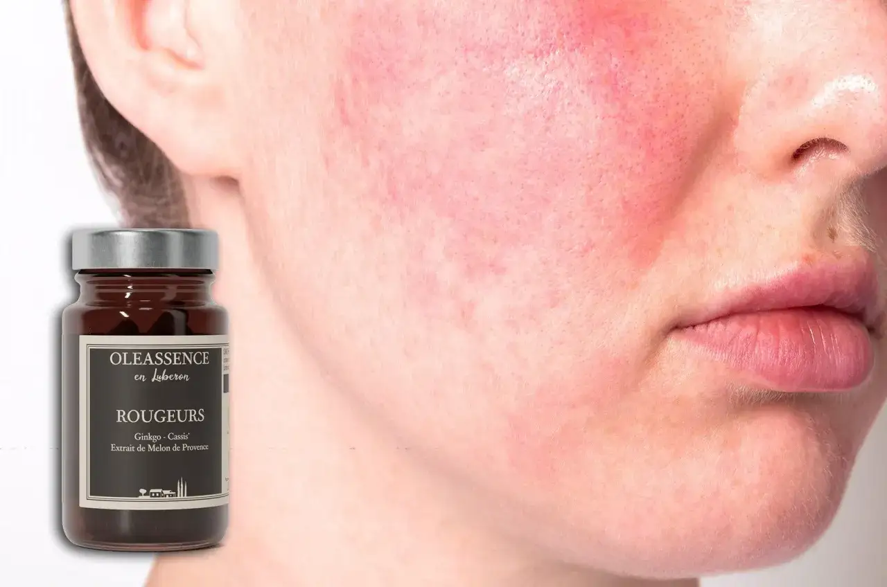 Gros plan sur une peau rougie, potentiellement atteinte de maladies de peau dues au stress. Une bouteille de produit 