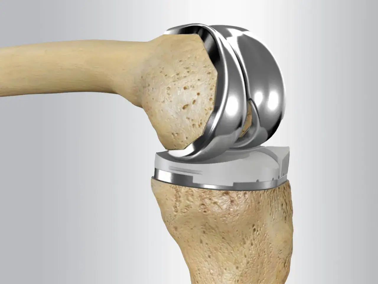 Prothèse de genou remplaçant une articulation endommagée par la polyarthrite rhumatoïde.