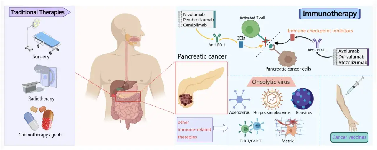 Immunoterapia nowotworów, w tym rak trzustki, wykorzystuje leki takie jak pembrolizumab do aktywacji komórek odpornościowych.