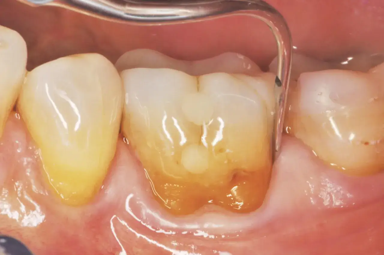Dente con tartaro visibile e gengiva infiammata. Uno strumento dentale esamina la sacca gengivale.