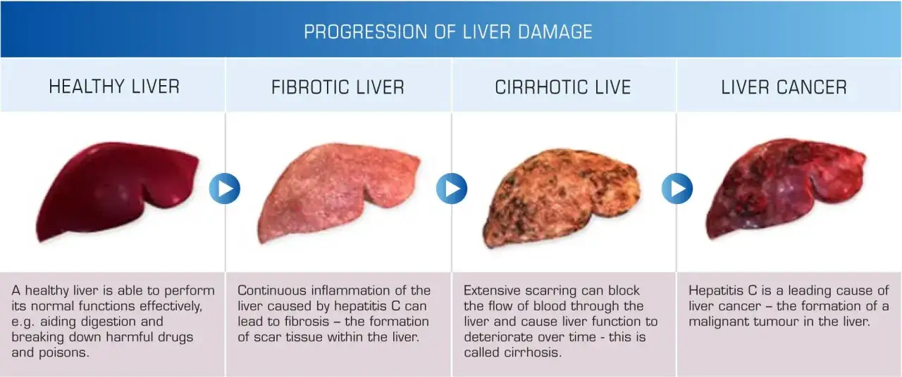 Progressione del danno epatico: fegato sano, fibrotico, cirrotico e con cancro. La cirrosi epatica guarigione è un percorso complesso.