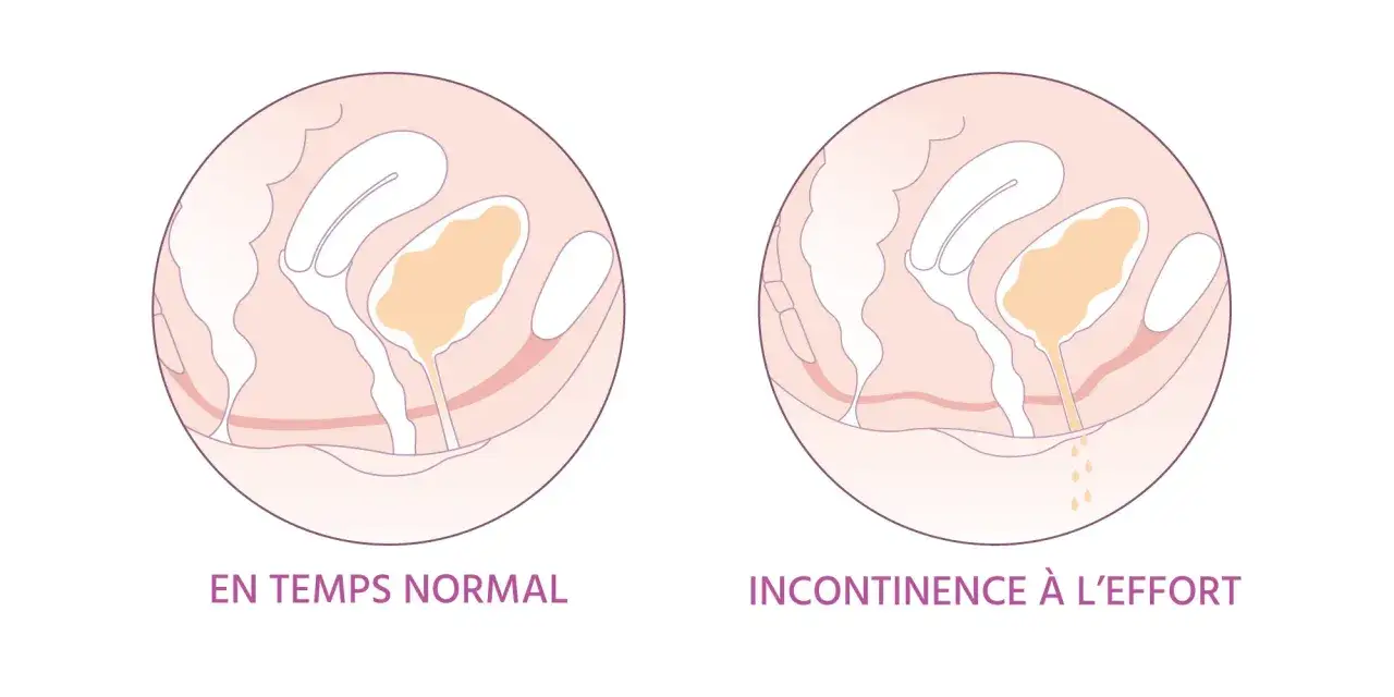 Illustration montrant la différence entre le contrôle normal de la vessie et l'incontinence à l'effort. Parfois, quand j'éternue, je fais pipi.