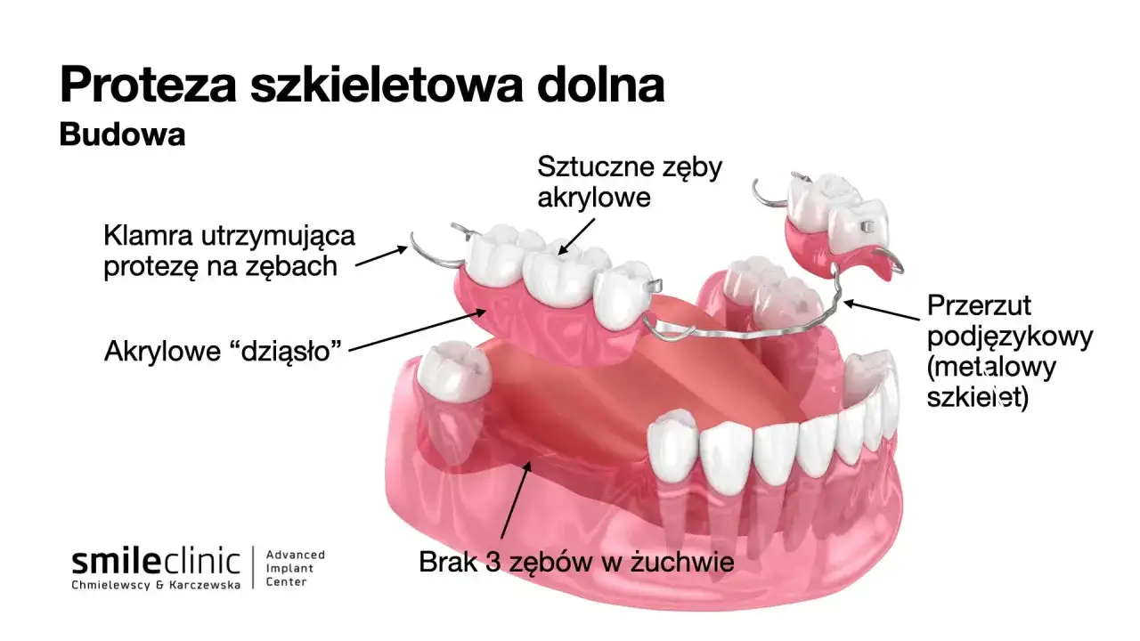 Proteza szkieletowa dolna: akrylowe zęby, klamry utrzymujące, metalowy szkielet. Świetna alternatywa co zamiast implantu, gdy brakuje zębów.