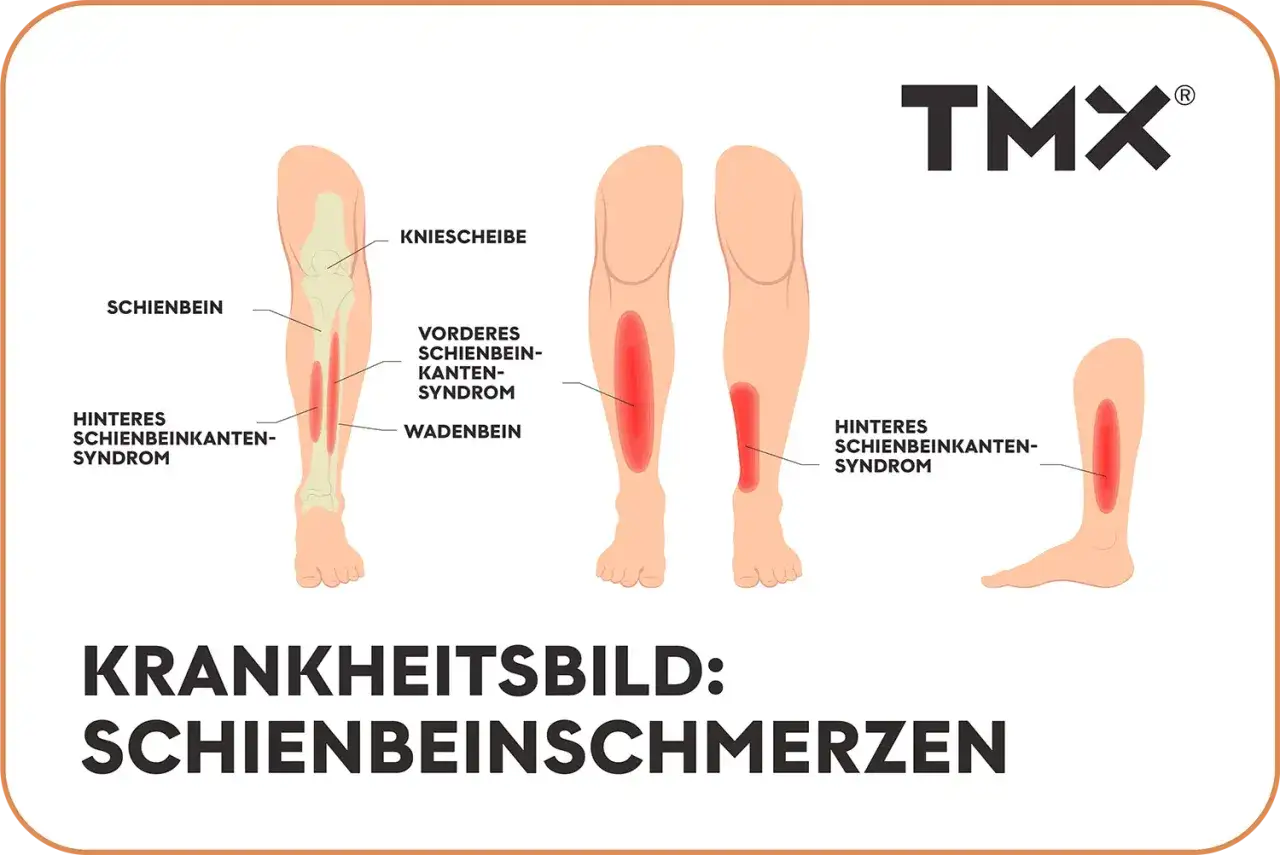 Illustrationen zeigen verschiedene Ursachen f&uuml;r starke Schmerzen im Schienbein im Ruhezustand, wie das vordere und hintere Schienbeinkantensyndrom.