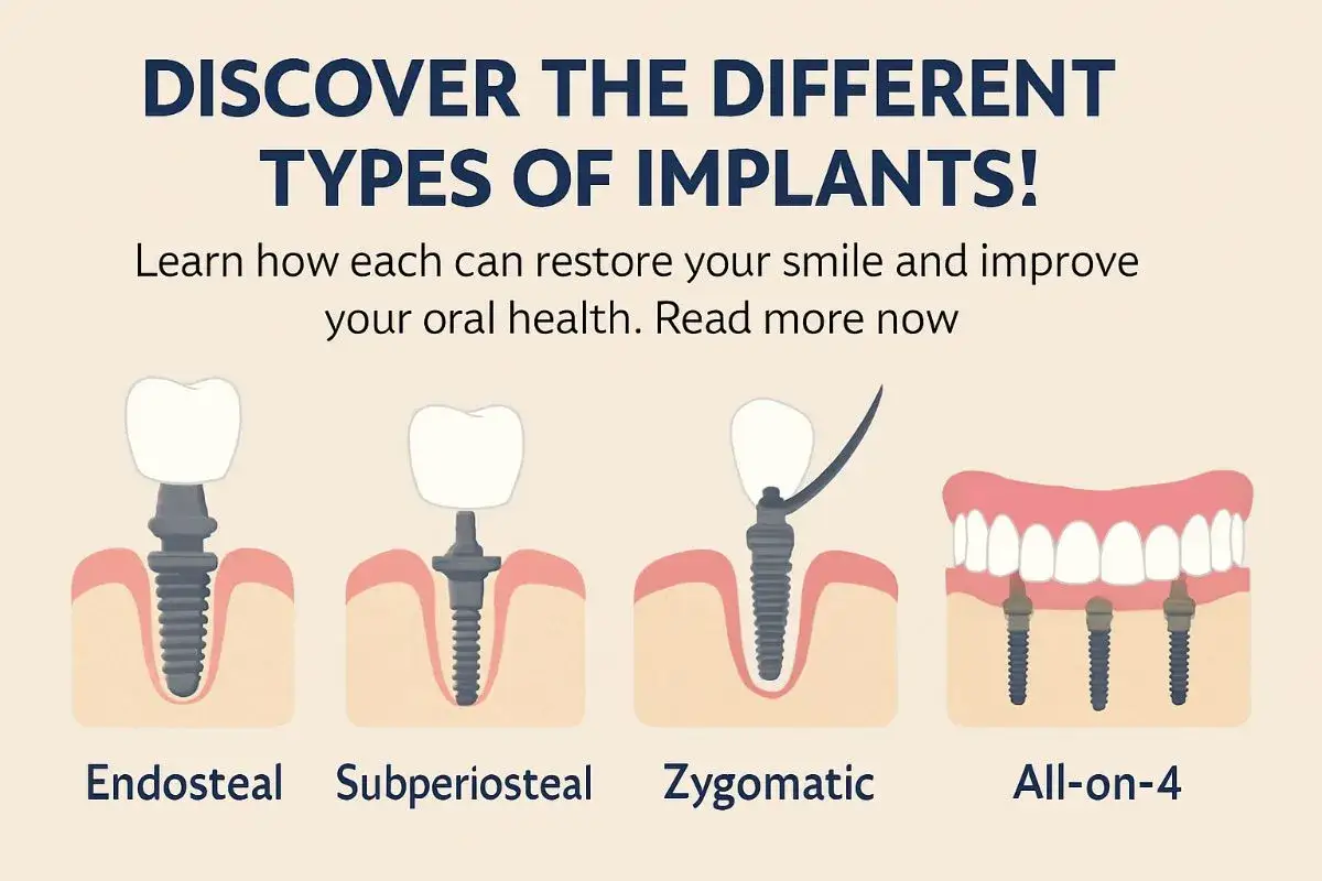 Illustrazione dei diversi tipi di impianti dentali: endosteale, subperiosteale, zigomatico e All-on-4.
