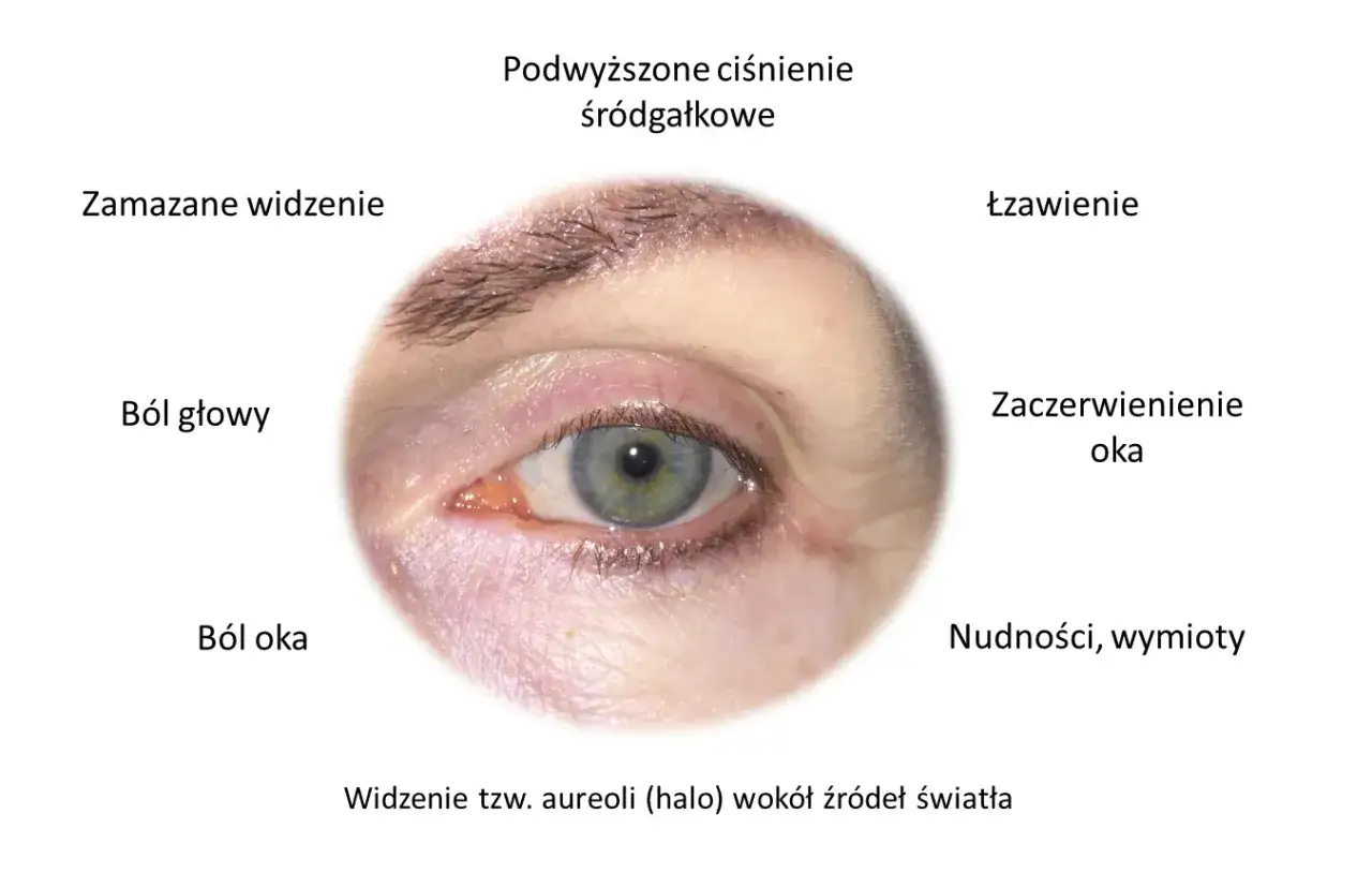 Nietypowe objawy jaskry: ból oka, głowy, zaczerwienienie, łzawienie, nudności, wymioty, zamazane widzenie, widzenie aureoli.