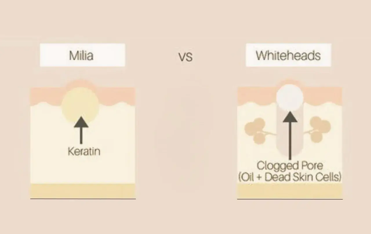 Illustration visar skillnaden mellan milier (inkapslade pormaskar av keratin) och whiteheads (igensatta porer med olja och d&ouml;da hudceller).