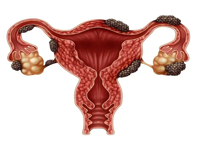 Mechanizm działania terapii hormonalnej w endometriozie