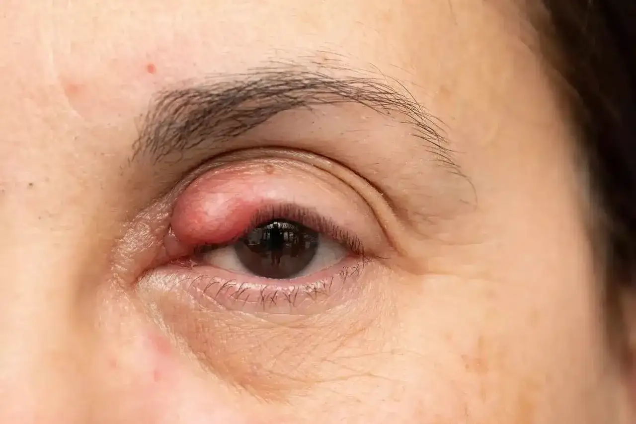 Gros plan sur un &oelig;il humain avec un bouton blanc sur la paupi&egrave;re sup&eacute;rieure, rouge et enflamm&eacute;.