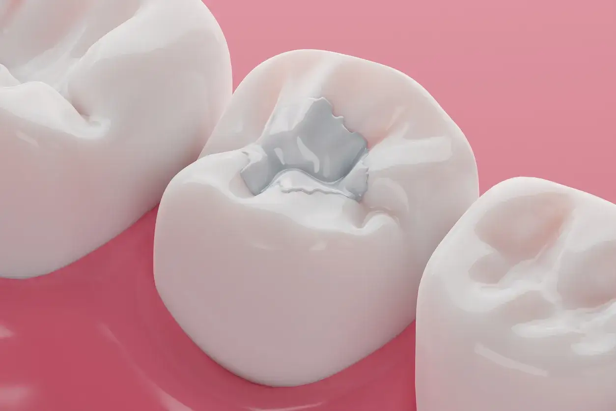 rodzaje plomb dentystycznych materiały